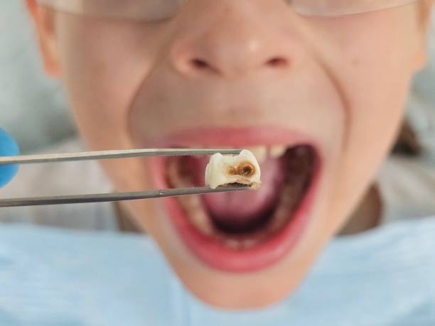 Best Urgent Tooth Repair  in Elk Ridge, UT